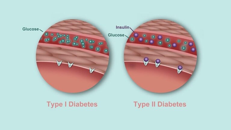 Differences between type 1 and type 2 diabetes